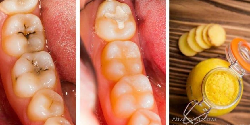 Acabe com as Cáries em 5 Minutos Sem ir ao Dentista Acabe com as Cáries em 5 Minutos Sem ir ao Dentista