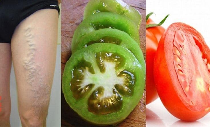 Curar Varizes com Tomate