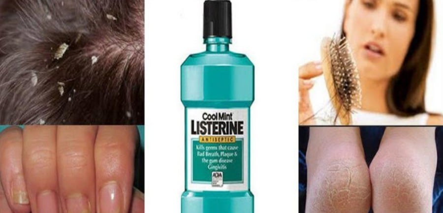 Acabe com as Caspas e Fungos nas Unhas Usando Listerine Acabe com as Caspas e Fungos nas Unhas Usando Listerine