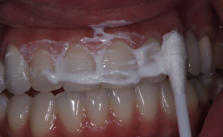 Remover Tártaro dos Dentes Remover Tártaro dos Dentes