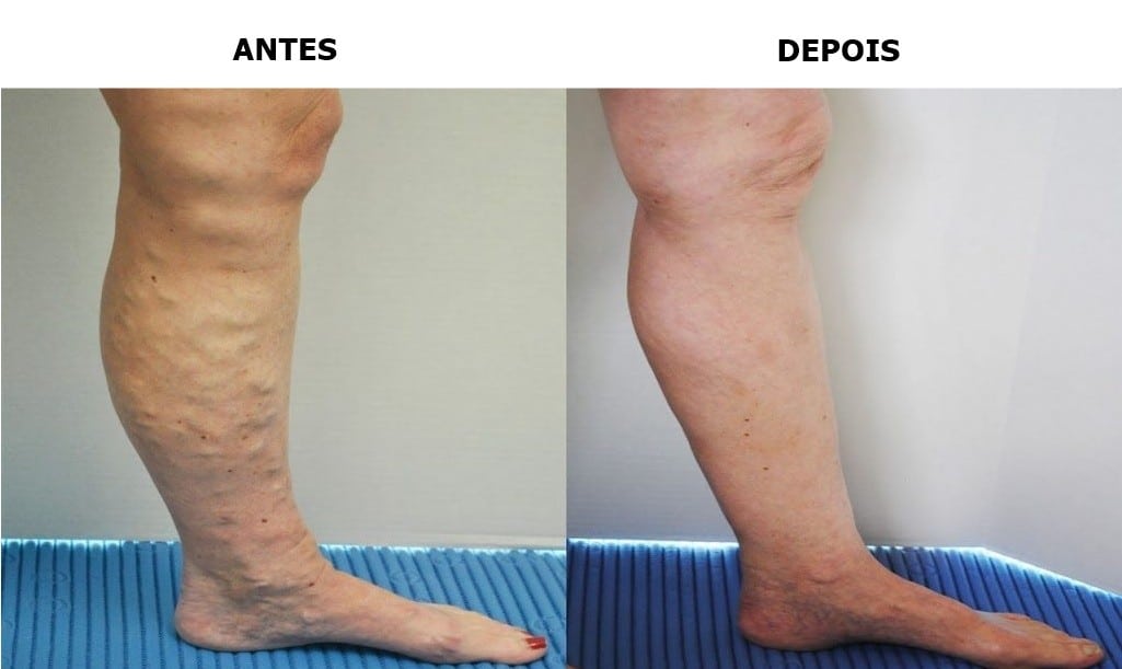 remover varizes naturalmente remover varizes naturalmente