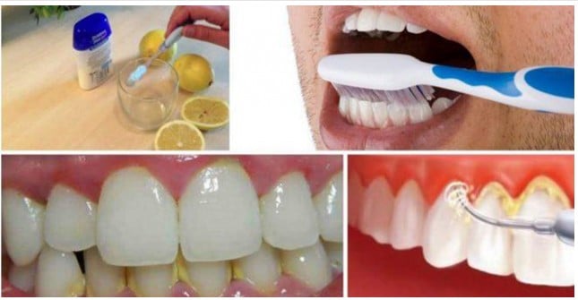 como eliminar o tártaro, placas e sangramento do dentes como eliminar o tártaro, placas e sangramento do dentes