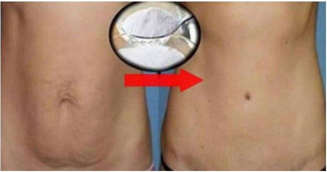 remover gordura da barriga com bicarbonato de sodio remover gordura da barriga com bicarbonato de sodio