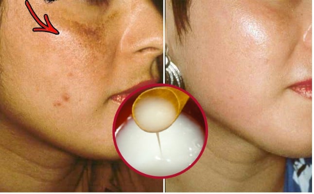remover as machas rugas e acne remover as machas rugas e acne