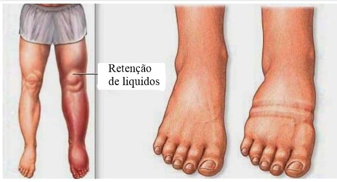 retenção de líquidos retenção de líquidos